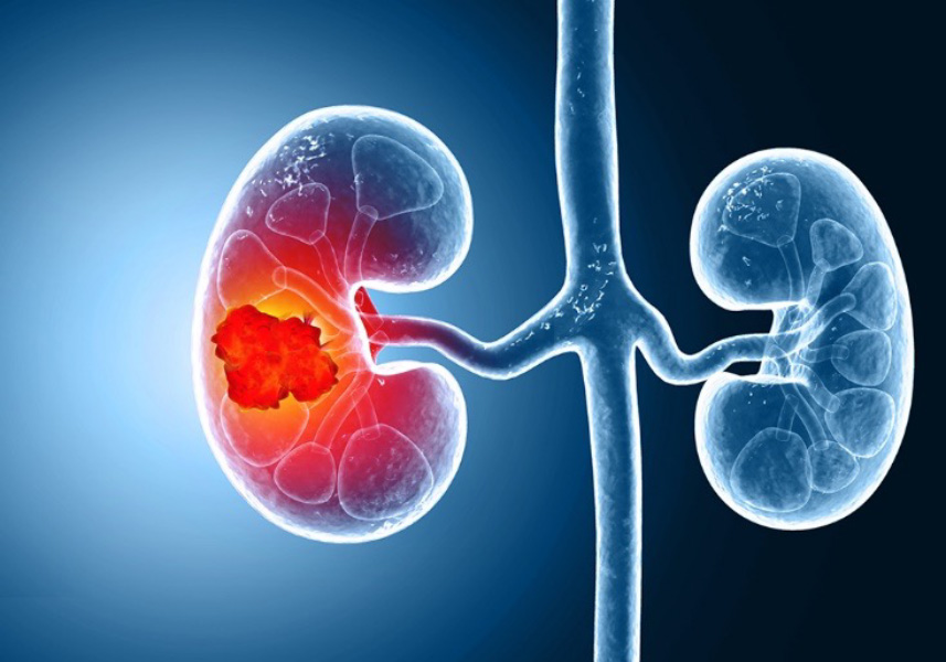 renal cell carcinoma picture on blue background example